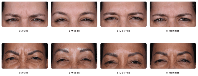 daxxify treatment results showing women with improved frown lines over time