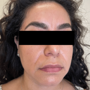 Facial Filler and Botox