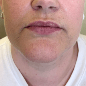 Lip Filler